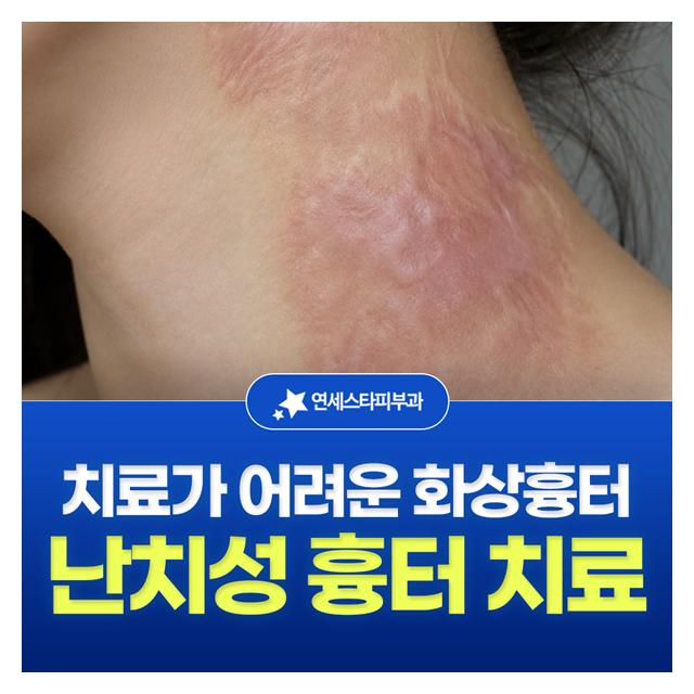 난치성 흉터 치료,치료가 어려운 화상흉터도 걱정마세요
